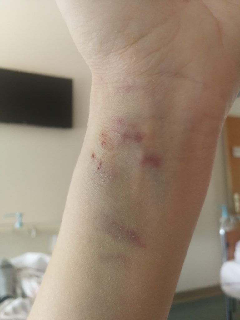 bruised wrist after surgery