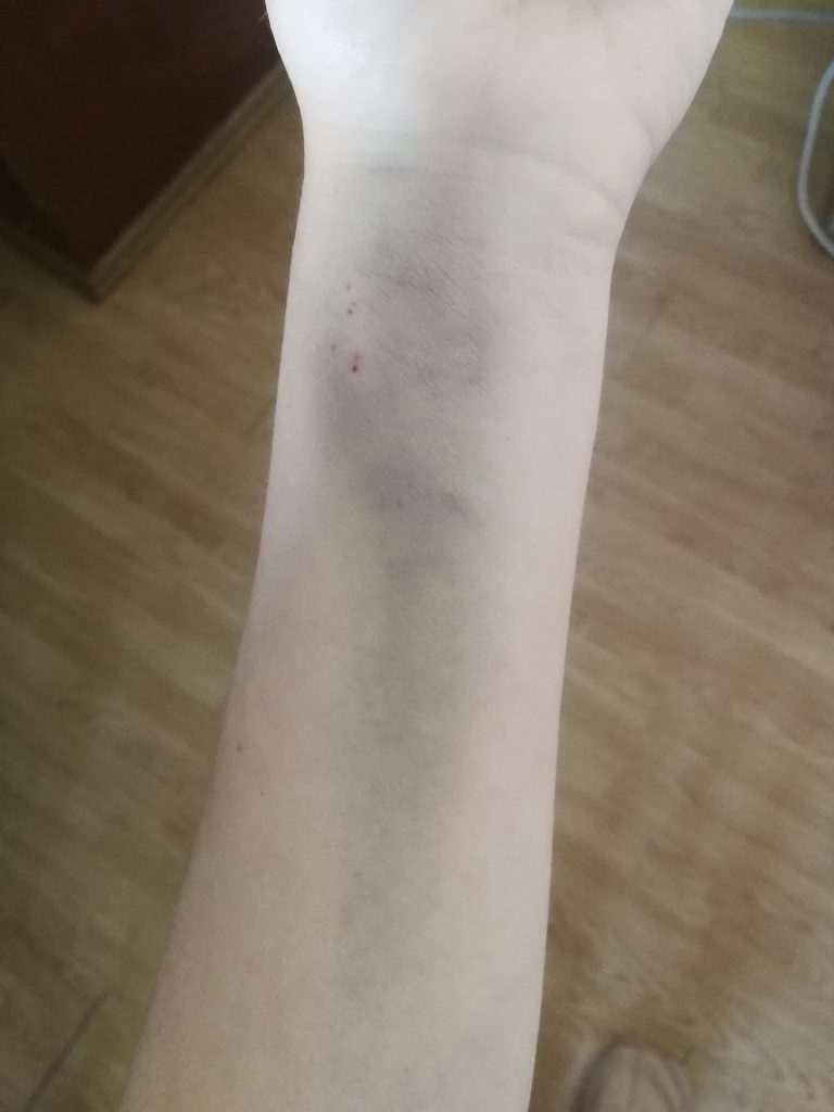 bruised wrist after surgery
